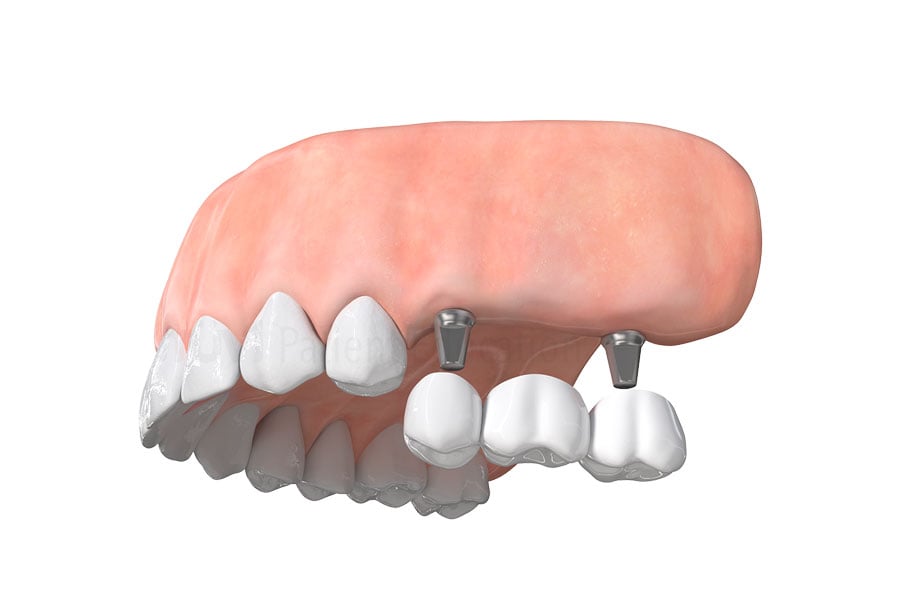 Dental Implant Bridge in White Plains, NY & Riverdale, NY