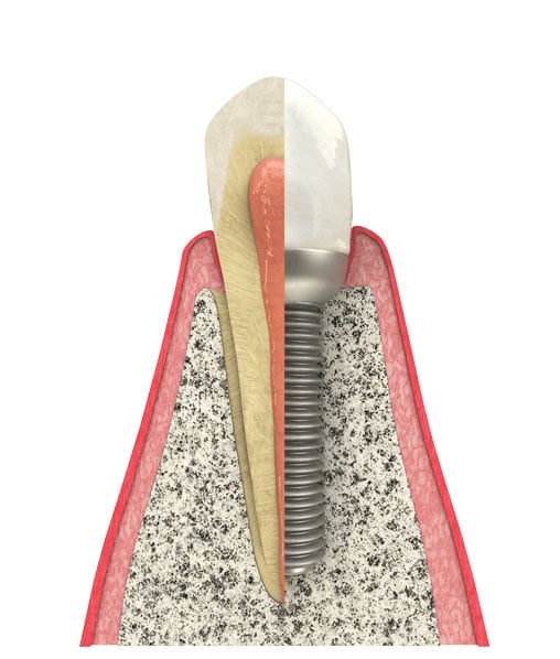 Benefits of Dental Implants in White Plains, NY & Riverdale, NY