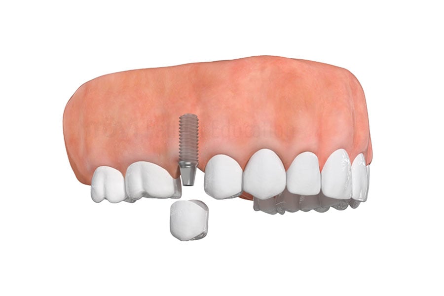 Dental Implant in White Plains, NY & Riverdale, NY