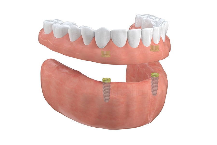 Implant-Supported Overdentures in White Plains, NY & Riverdale, NY