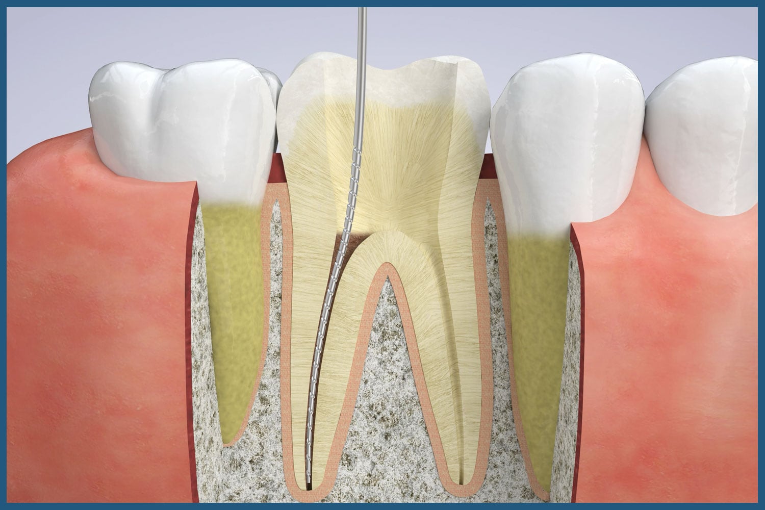 Stages of Root Canal Therapy in White Plains, NY & Riverdale, NY