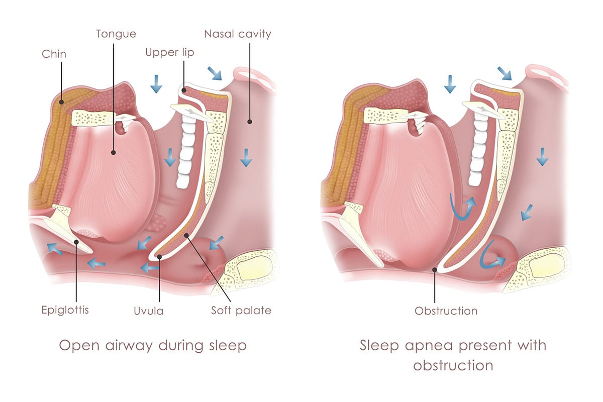 Sleep Apnea in White Plains, NY & Riverdale, NY